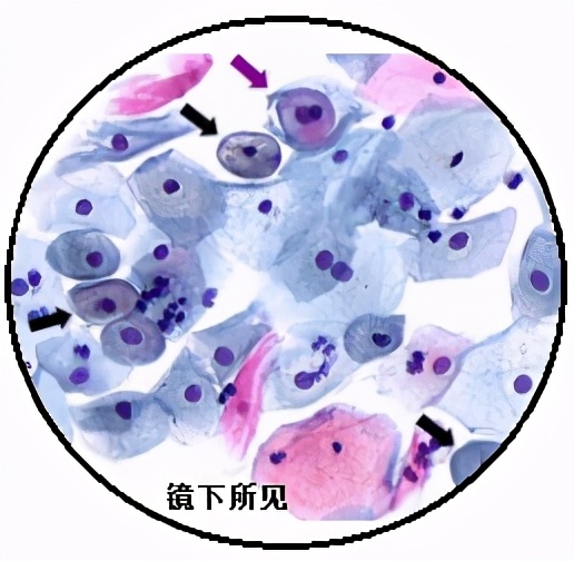 TCT、阴道镜、CIN、锥切(leep)都是什么意思?