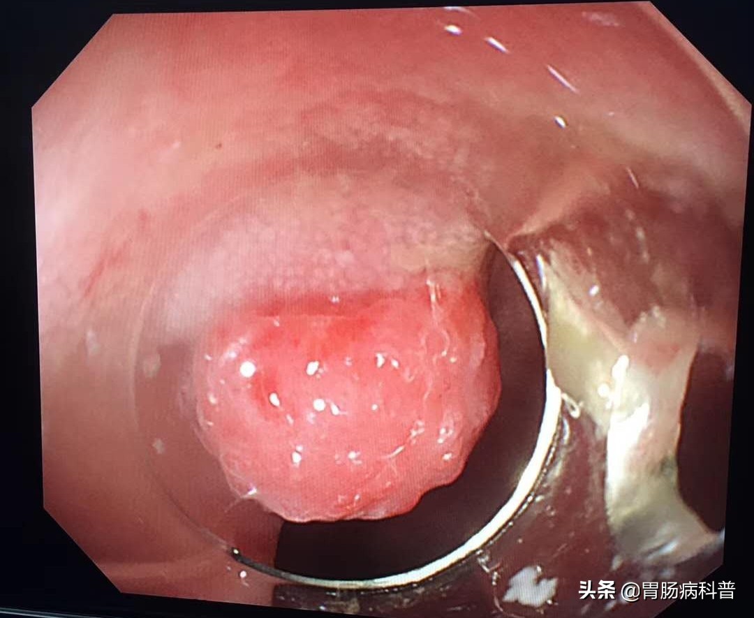 儿童拉血直肠息肉怎么治,3岁的孩子直肠息肉排便带血