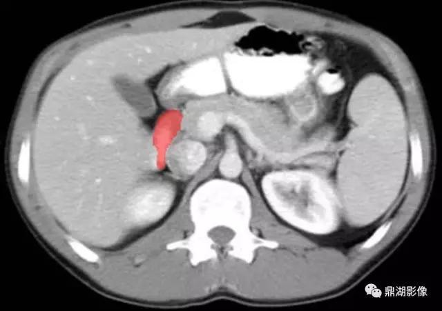颈部胸锁乳突肌ct断层解剖图,骨盆骨质正常断层ct解剖图解