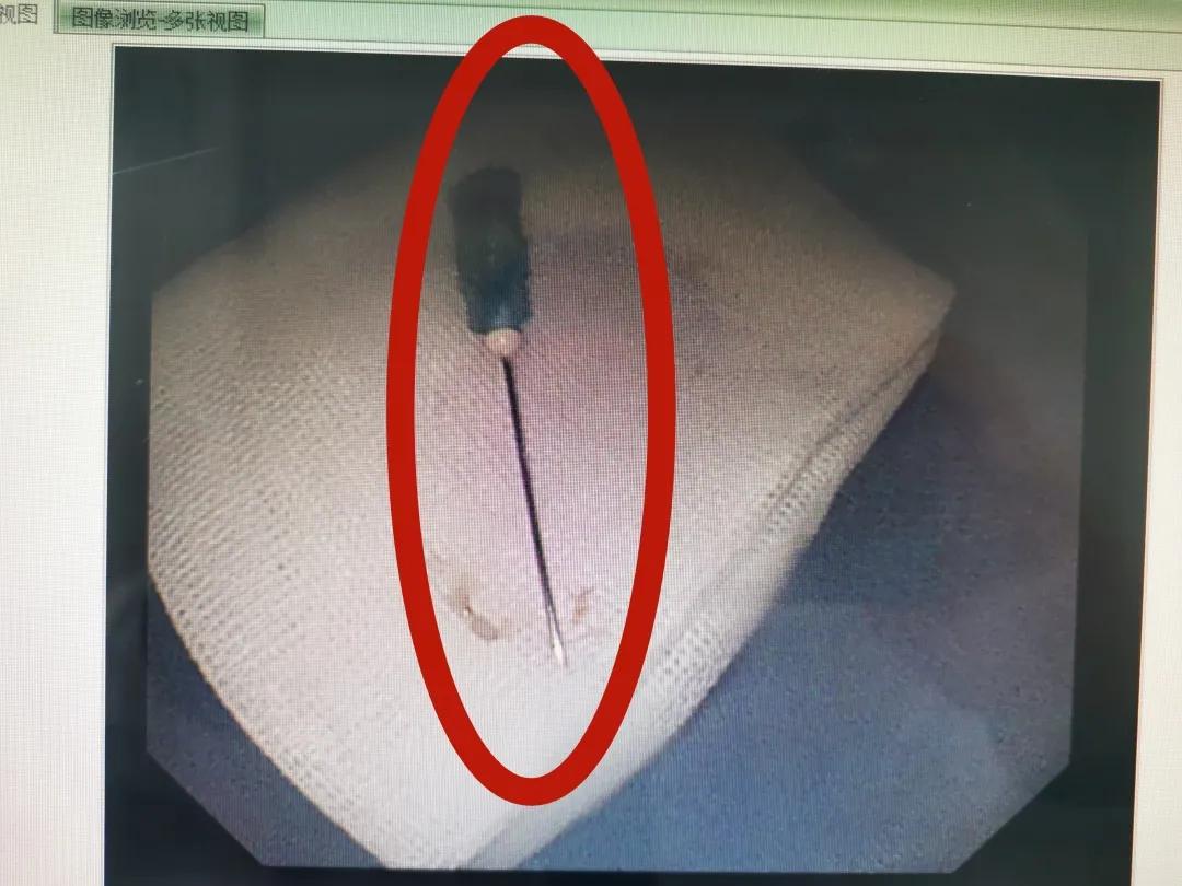 惊险！威海一宝宝吞下注射针头