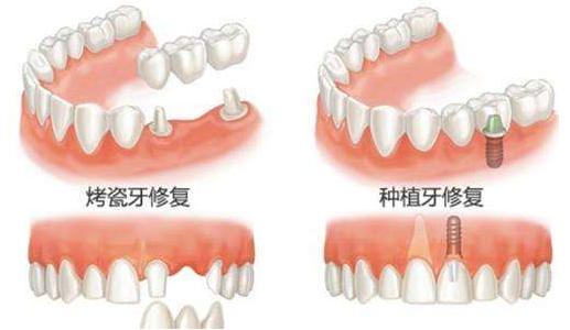 后槽牙缺失不想种植还有什么方法,牙齿缺失的修复方式有哪些