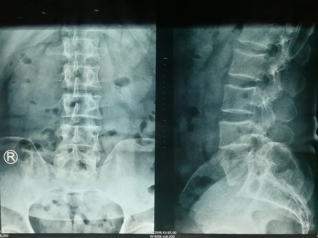 腰椎间盘突出症治疗,1个反射动作引出,提示治愈,医生很开心