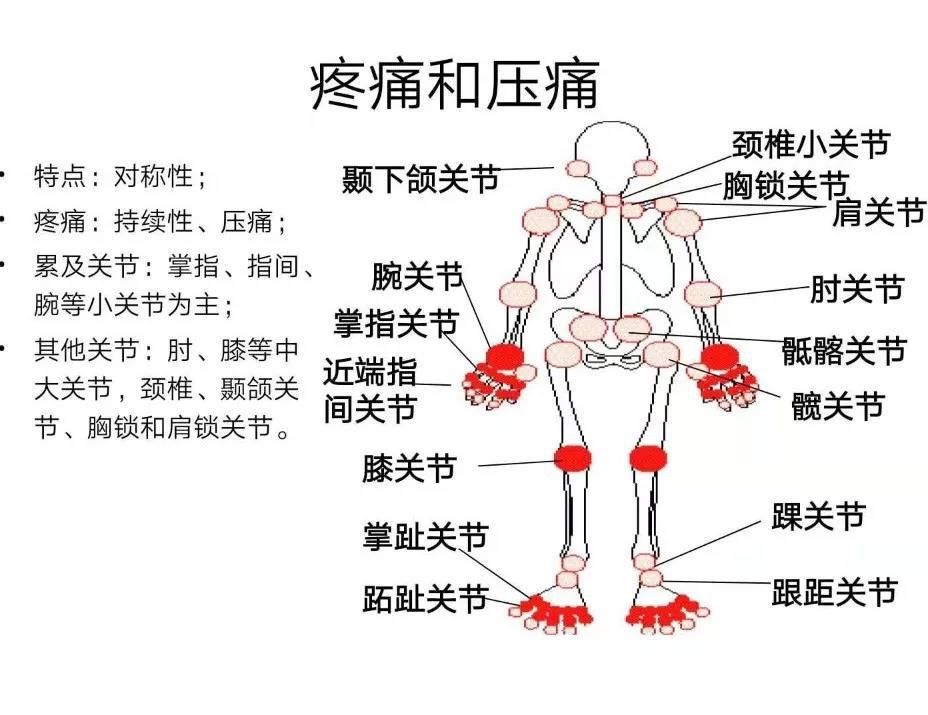 判断类风湿关节炎最简单方法,类风湿关节炎符合慢性疾病的条件