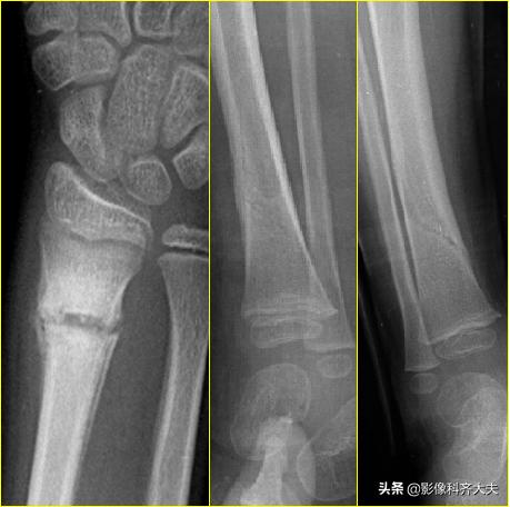 骨折的影像学检查及各自的优势,骨折的影像学愈合标准