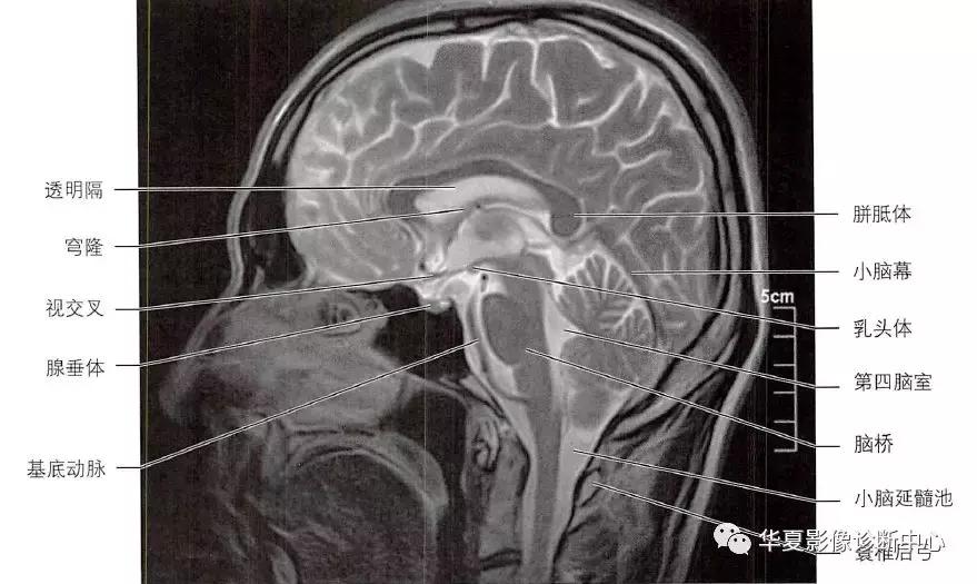 透明隔腔与透明囊肿鉴别,透明隔间腔与囊肿区别