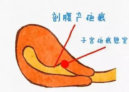 剖宫产后经期延长怎么治,剖腹产后经期延长是怎么回事