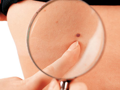 色素痣有可能恶变吗,色素痣恶变的几种可能性