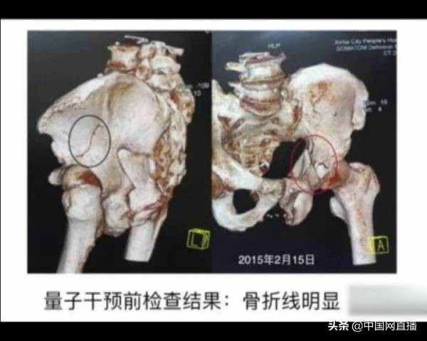 “量子远程治病”又来了，有人被骗11万