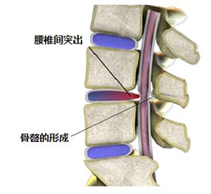 腰椎间盘突出疼痛的最好方法,腰椎间盘突出吃什么营养神经药物