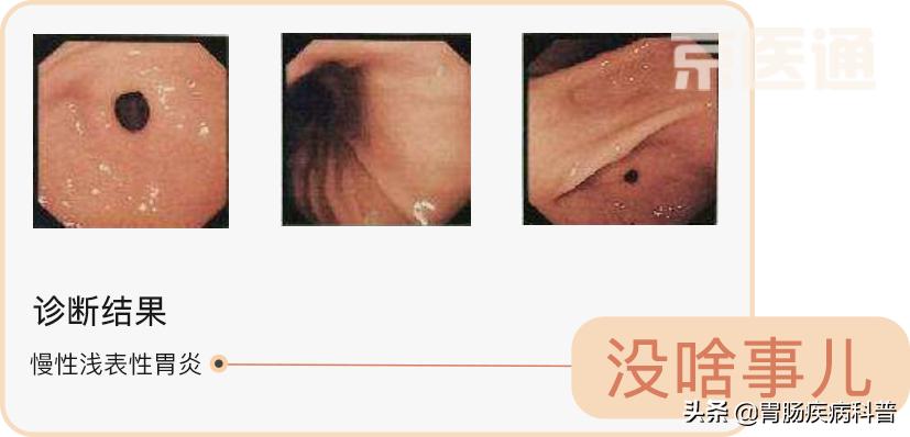 肠胃镜报告要等多久,教你3分钟看懂胃镜活检病理报告