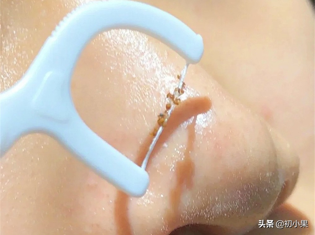 鼻子上的黑头怎么去除,鼻子上的黑头怎么去除小孩