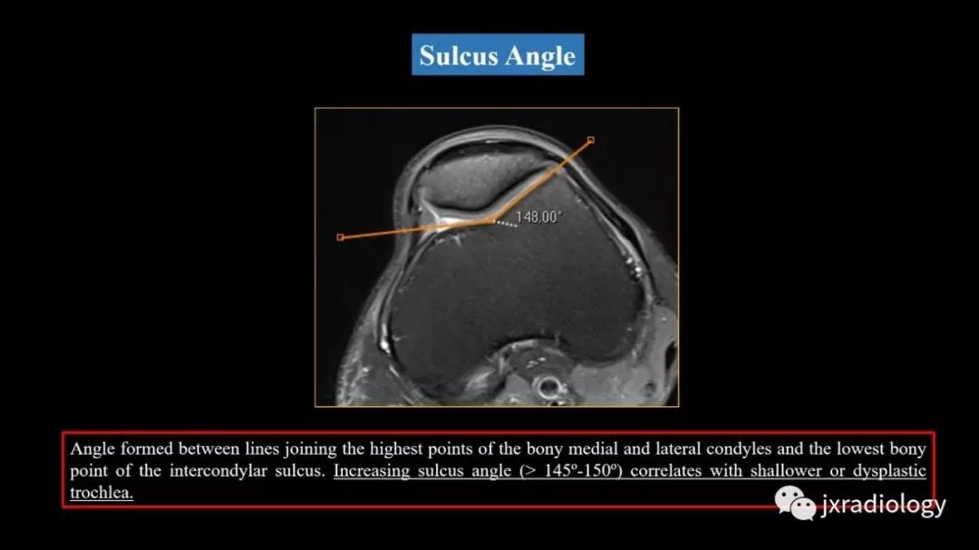 髌股关节失常磁共振看什么,髌股关节混乱的影像评估
