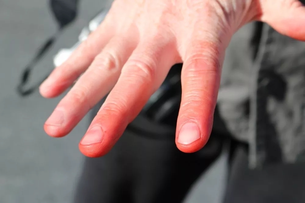 寒冷天气预防冻疮措施,寒潮来袭防寒