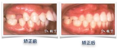牙齿矫正10000元能搞定吗,牙齿矫正花费报销