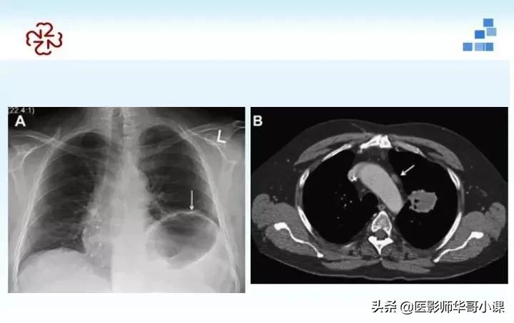 「精品课件」胸部膈肌的解剖及常见病变影像的表现
