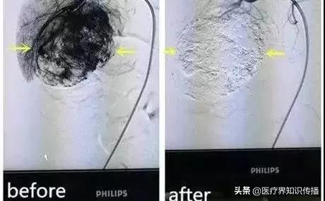 肝血管瘤中医治疗方法,肝血管瘤需要治疗么