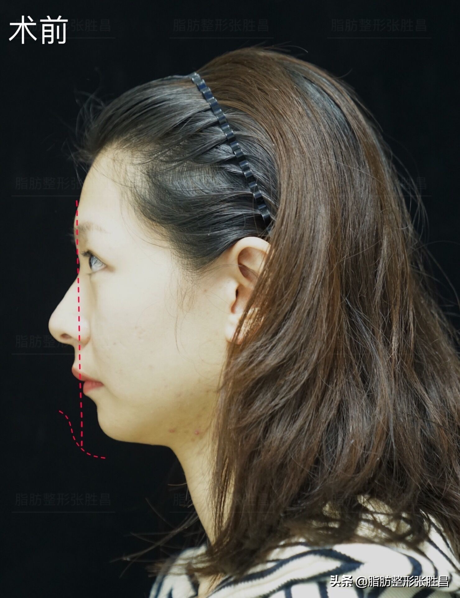 下巴缩短整容女,下巴短小北京