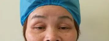 眼整形常见手术方式,眼整形美容手术