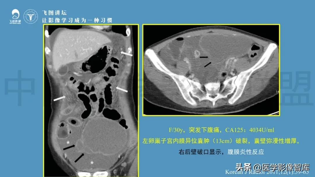 子宫解剖结构输卵管和卵巢位置,子宫附件ct影像学正常解剖表现
