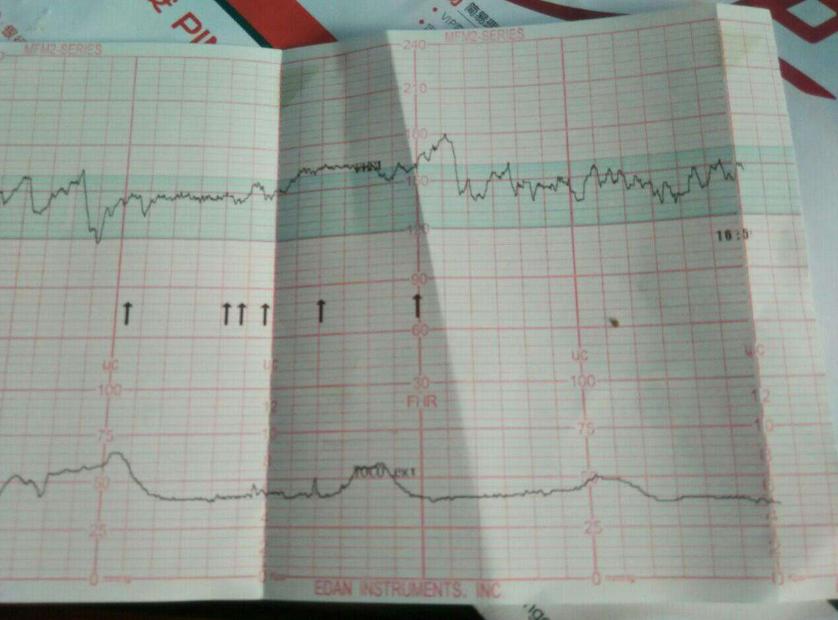 临近产期胎儿入盆，是快要生了吗？胎儿入盆孕妈会有这些感觉