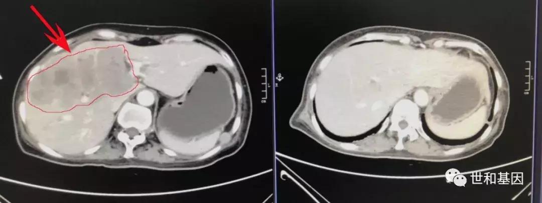 精益求精，抗血管和免疫药物的临床应用经典病例丨束永前教授