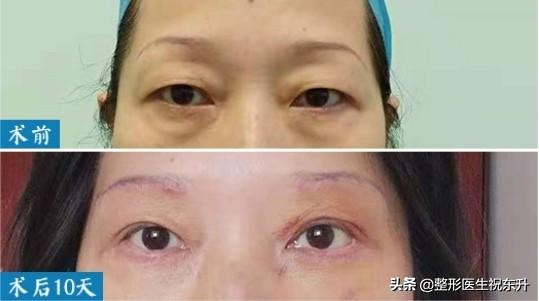 上眼皮松弛下垂做什么手术不留疤,提眉和上眼睑松弛矫正有啥区别