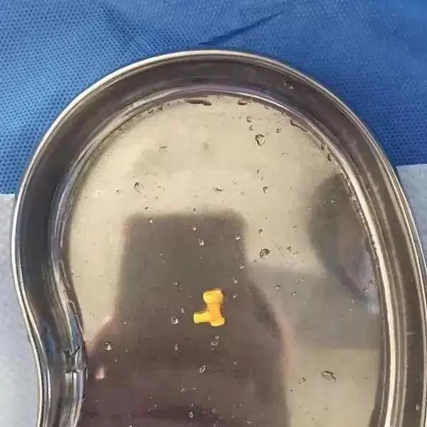 女孩误吞玩具,女童误吞了小玩具电池怎么办