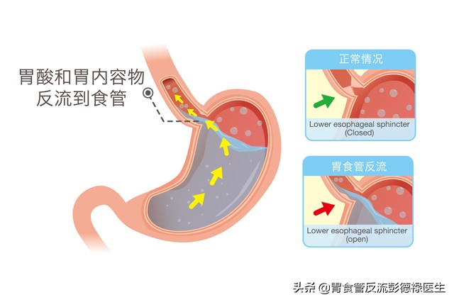 咽部异物感咳嗽怎么回事,咽痒咳嗽有异味久治不愈怎么办