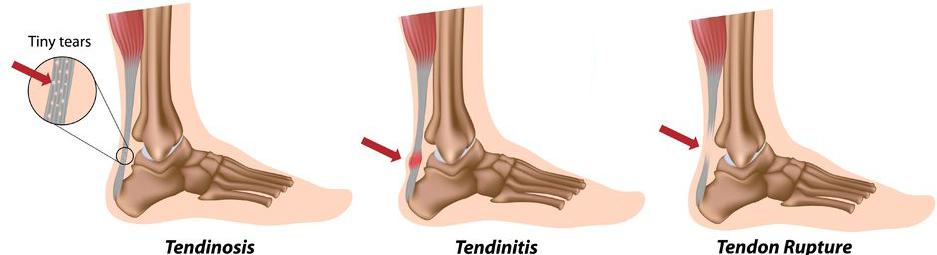 伸直后腿筋疼是怎么回事,前脚踝撞击综合征怎么治疗