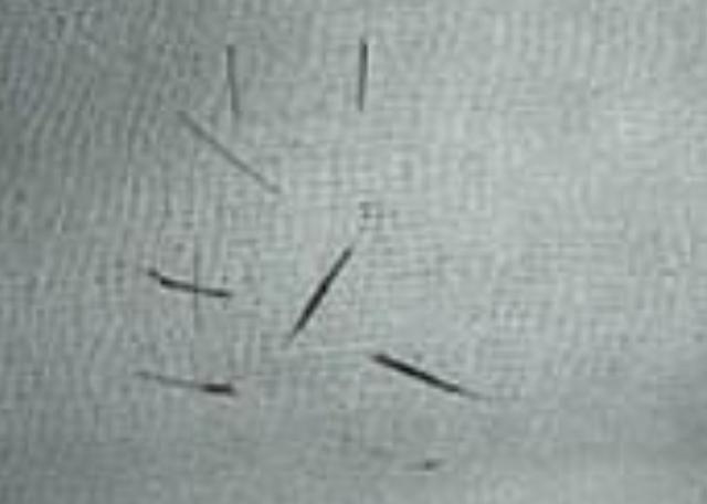 女孩牙龈罕见长出毛发,医生:之前都是男性