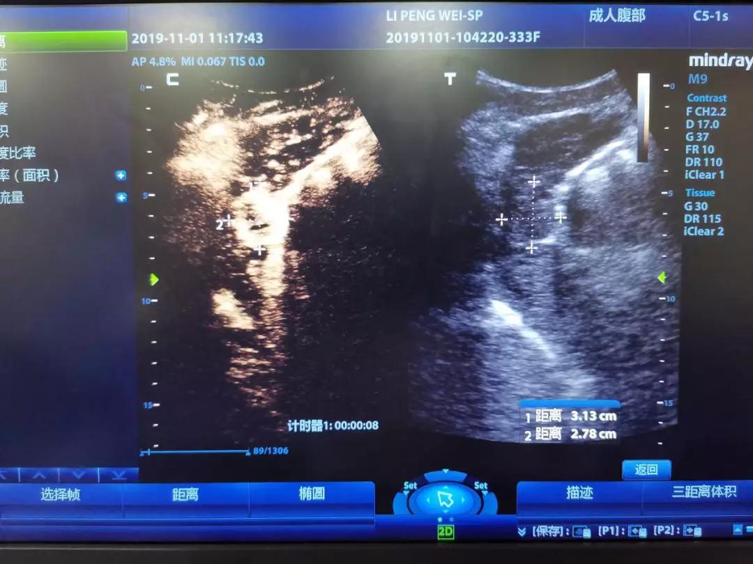陕西中医药大学超声医学,射频消融术对肝癌治疗的疗效