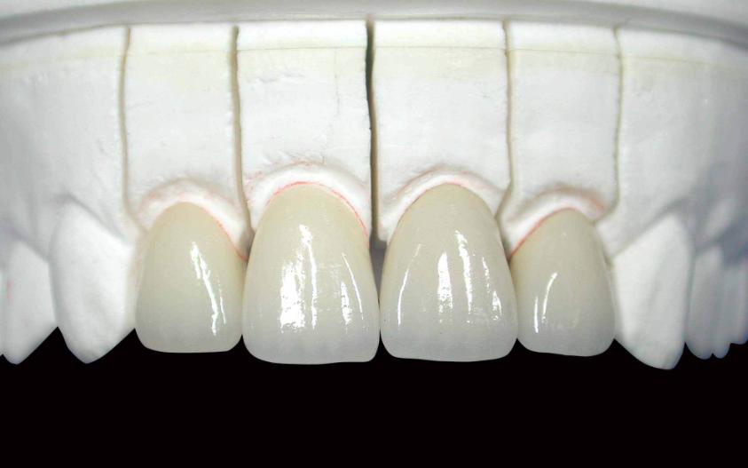 全瓷牙和烤瓷牙有什么区别哪个好,到底是烤瓷牙好还是全瓷牙好呢