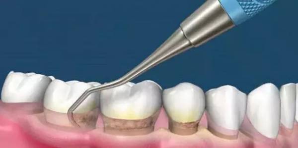 洗牙到底怎么洗好,洗牙洗的不干净