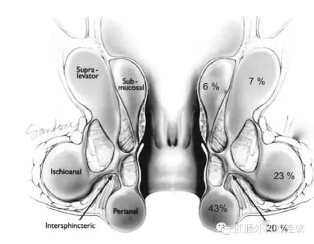 肛周脓肿手术恢复和深浅有关吗,为什么肛周脓肿手术这么难恢复