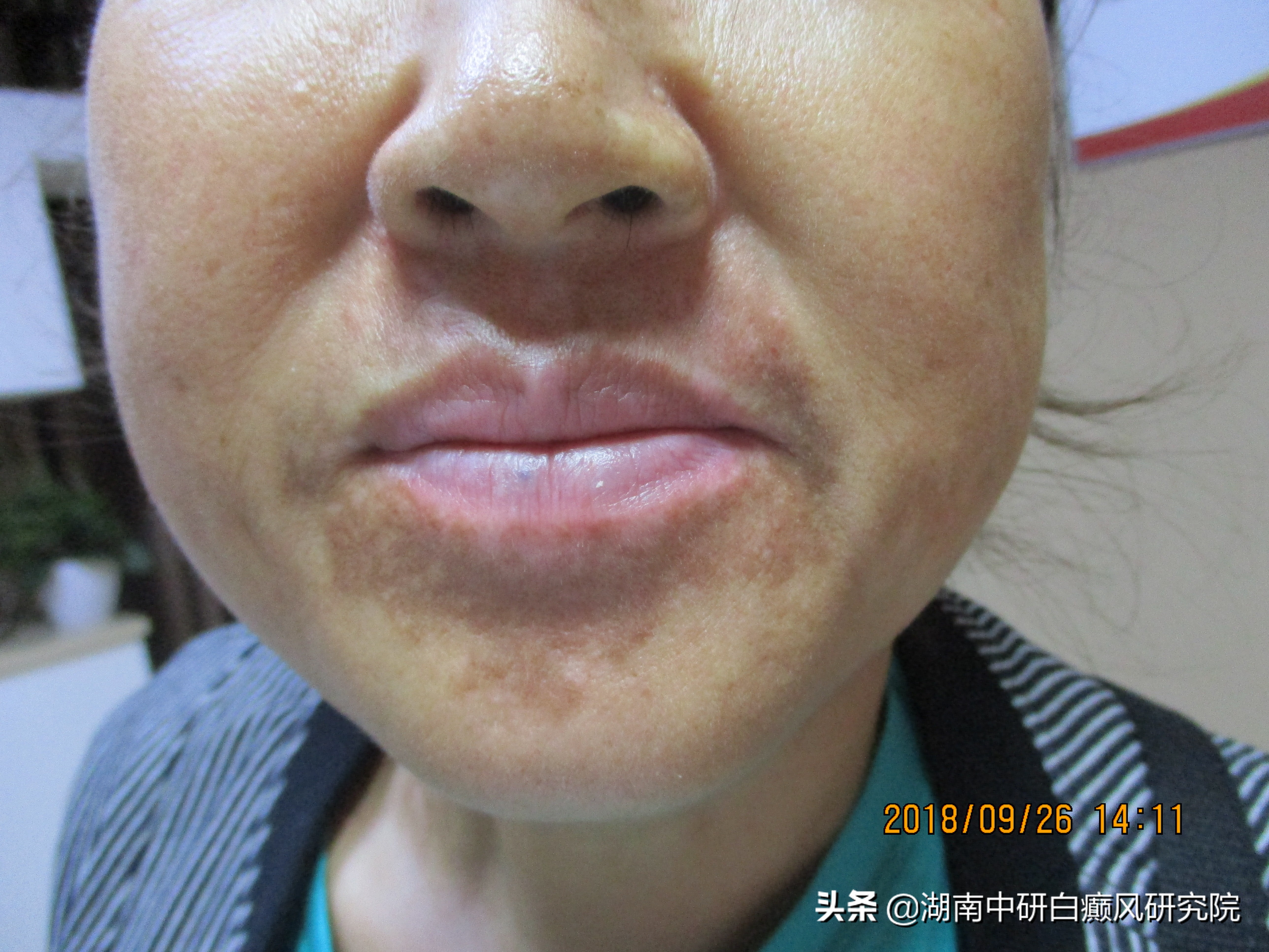 一位面部白癜风的患者，从患白到康复，她经历了什么？