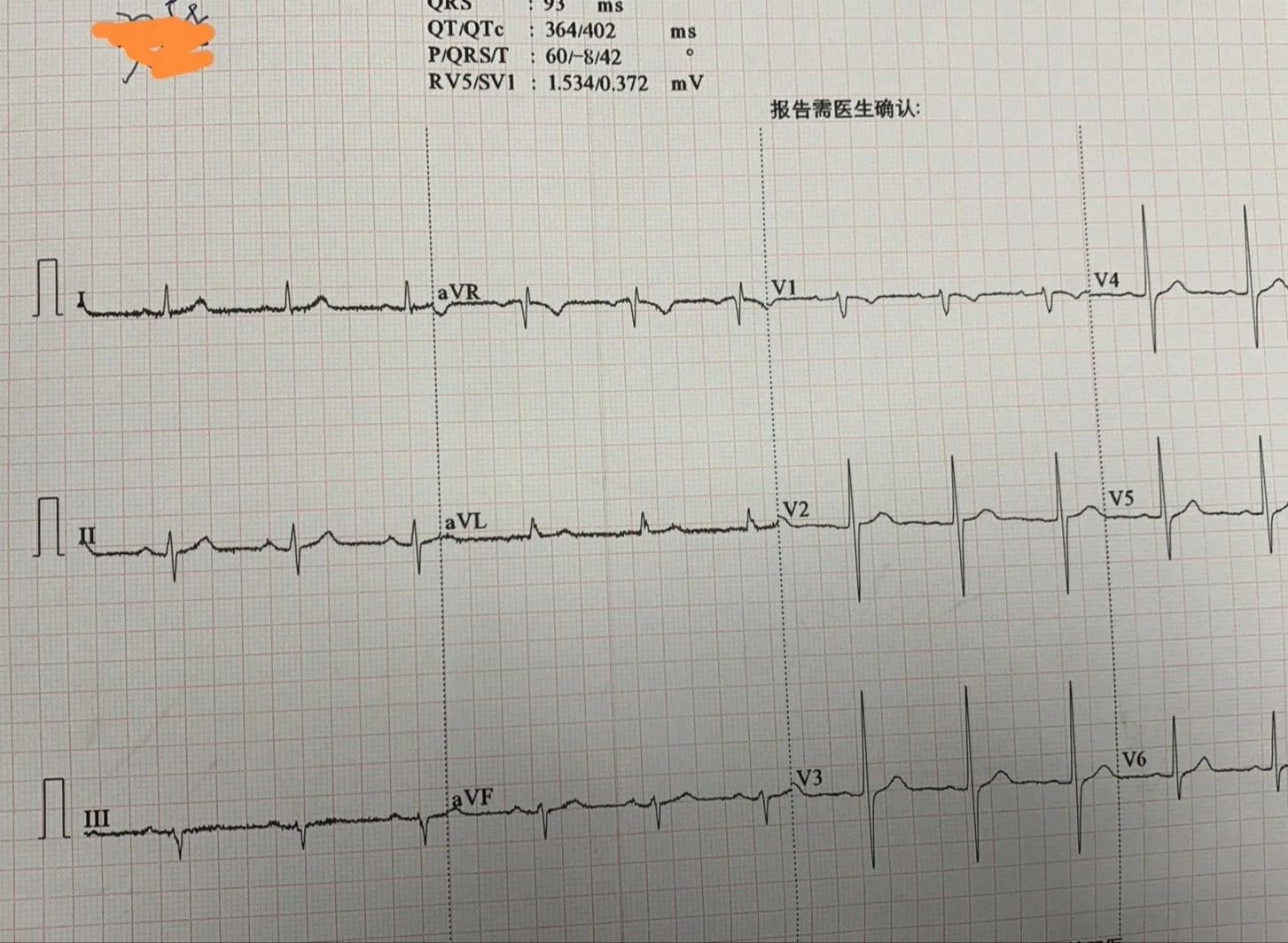 atp术式治疗冠脉分叉病变,冠脉分叉处堵塞能治吗