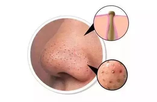 5种简单又有效的去黑头方法,简单的不伤皮肤的去黑头方法