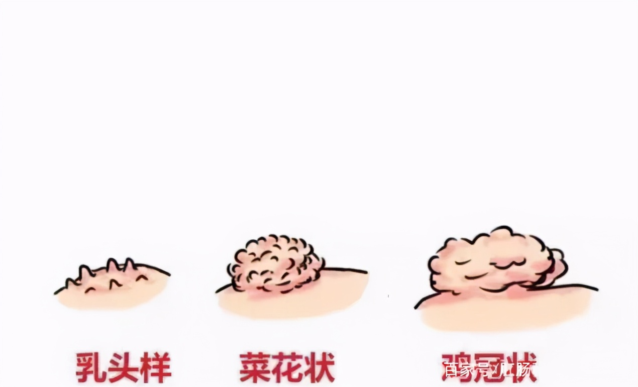 “菊花”不适，不一定都是“痔疮”的锅