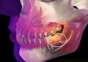 所有人拔智齿都会肿吗,智齿拔了以后智齿还有什么用