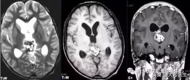 钙化灶是良性肿瘤的可能性大吗,颅内肿瘤钙化发生率最高