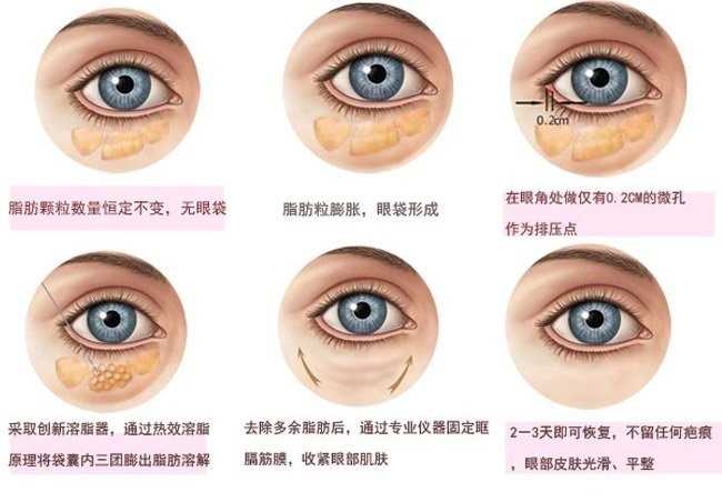 如何消除眼袋,如何消除眼袋泪沟的方法