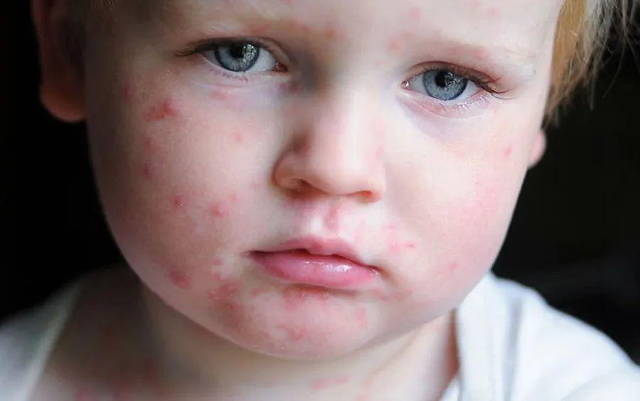 宝宝夏季湿疹挠破皮,宝宝湿疹挠破了有渗液怎么办