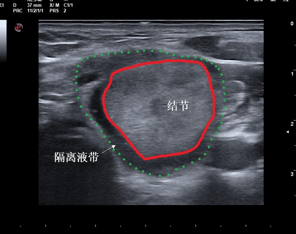 甲状腺结节微创消融手术,甲状腺结节微创消融医保