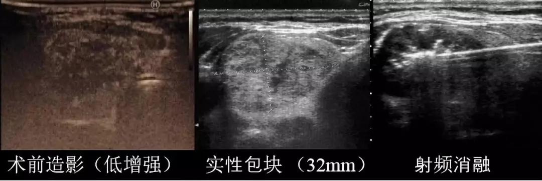 发现甲状腺结节和乳腺结节怎么办,怀孕后发现甲状腺结节4a级怎么办