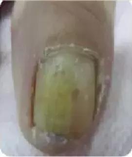 足疗店灰指甲治疗费用大概多少钱,得了灰指甲一个传染俩靠谱吗