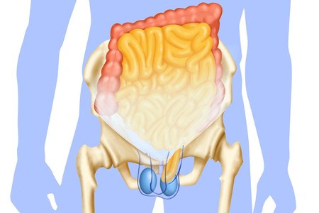 啥是腹股沟疝气,什么是腹股沟疝气有什么症状