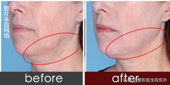 超声刀为什么一个月才能看到效果,超声刀真的会有效果吗