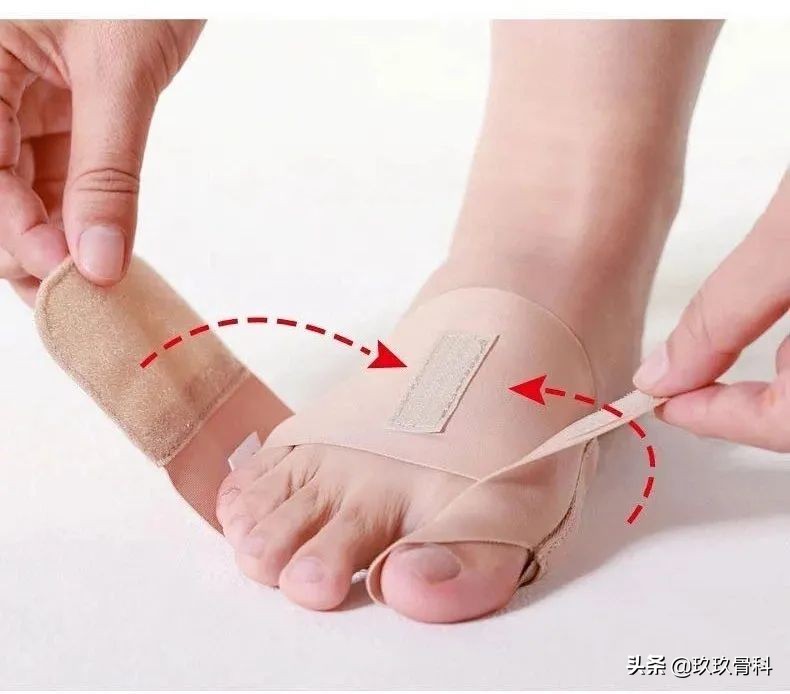 拇外翻的女人命真的苦吗,困扰女性的拇外翻