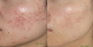 不同痘坑凹洞擦什么药膏,不同痘坑怎么修复