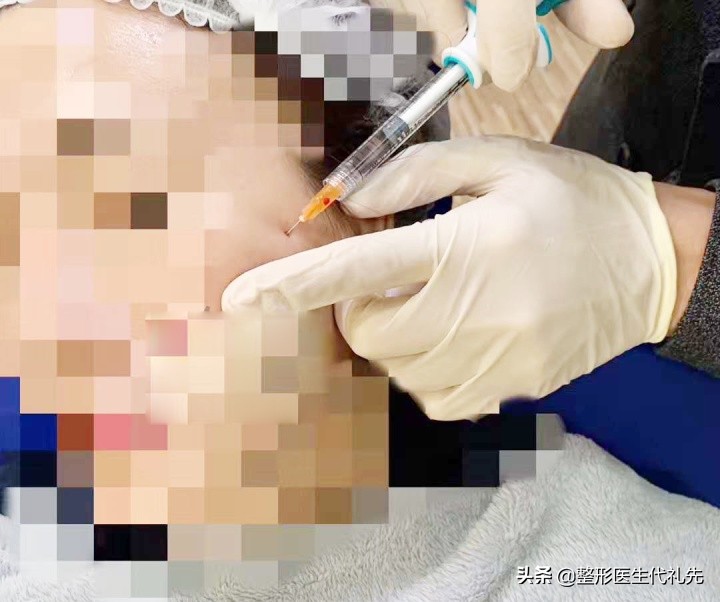 打美白水光针几次可以看到效果,水光针用哪种针注射好